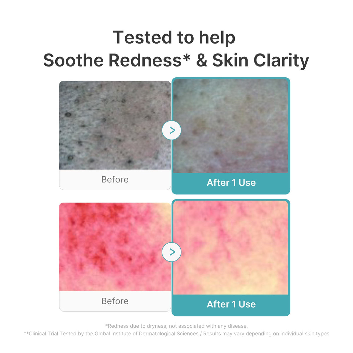 Azelaic Acid Capsule Foam Cleanser V5